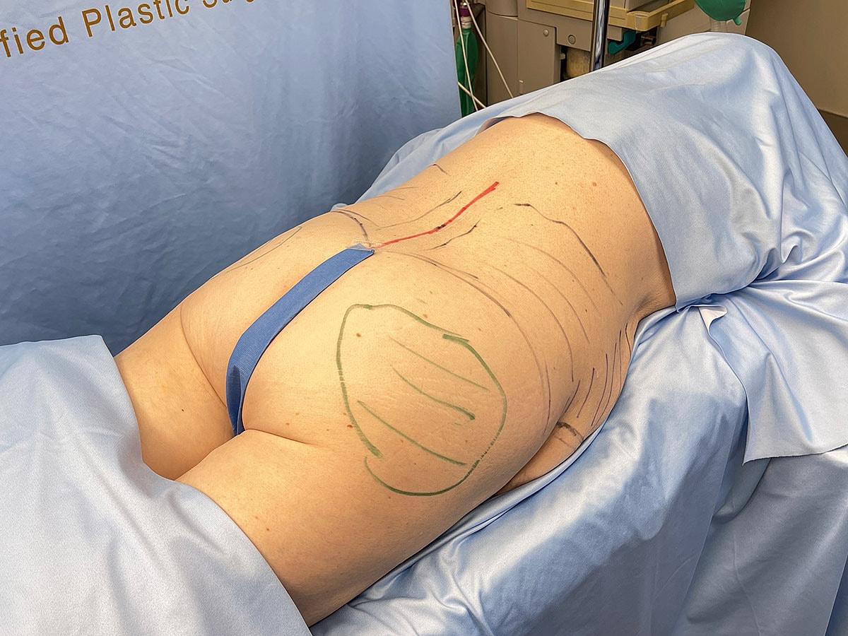Surgical markings on patient’s back before procedure.