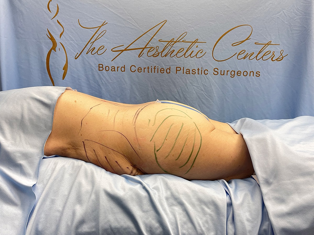 Patient preparation for body contouring procedure.