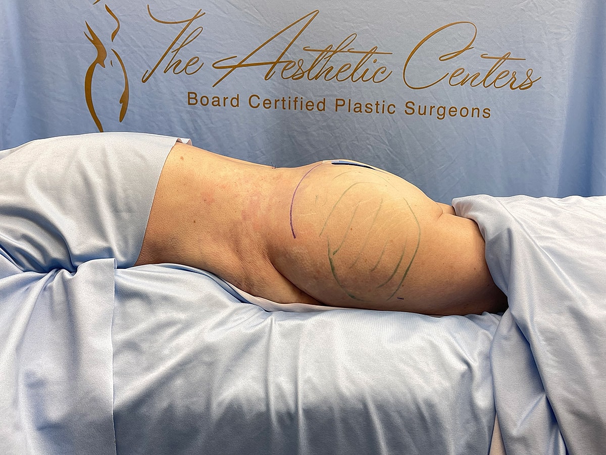 Patient preparation for cosmetic surgery procedure.