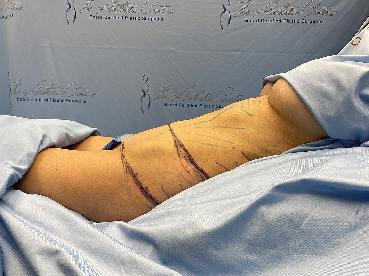 Surgical markings on patient's torso before procedure.