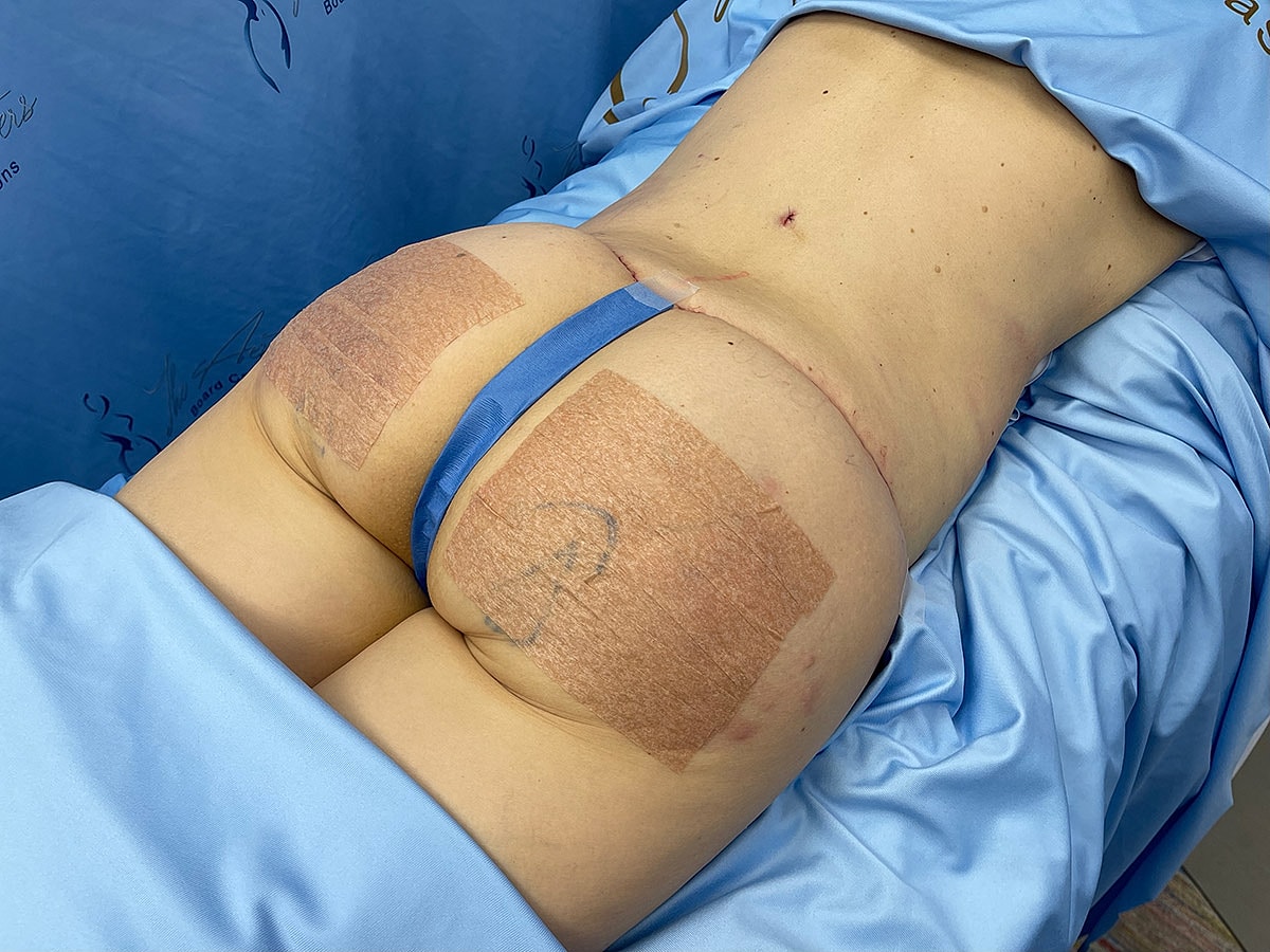 Post-surgery recovery area on the lower back.