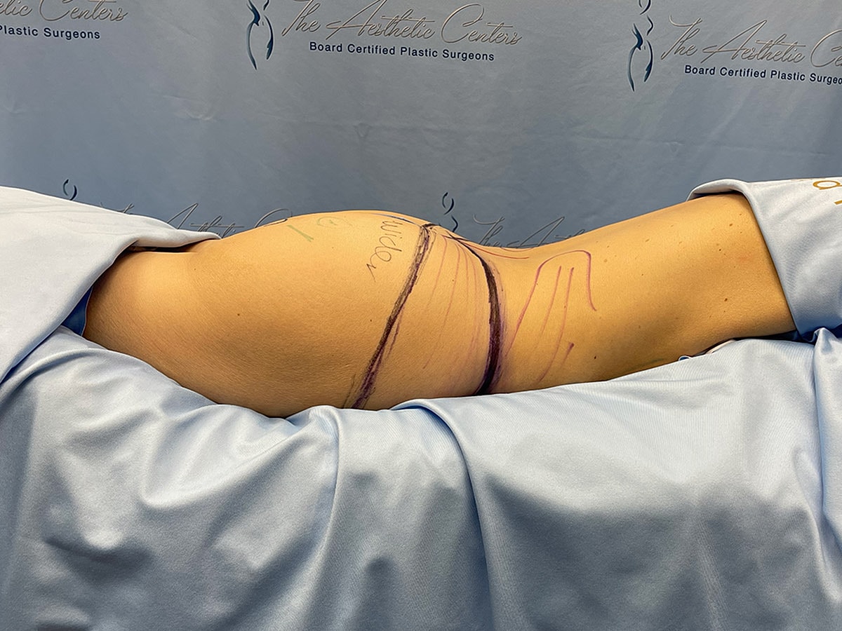Surgical markings on a patient's side.