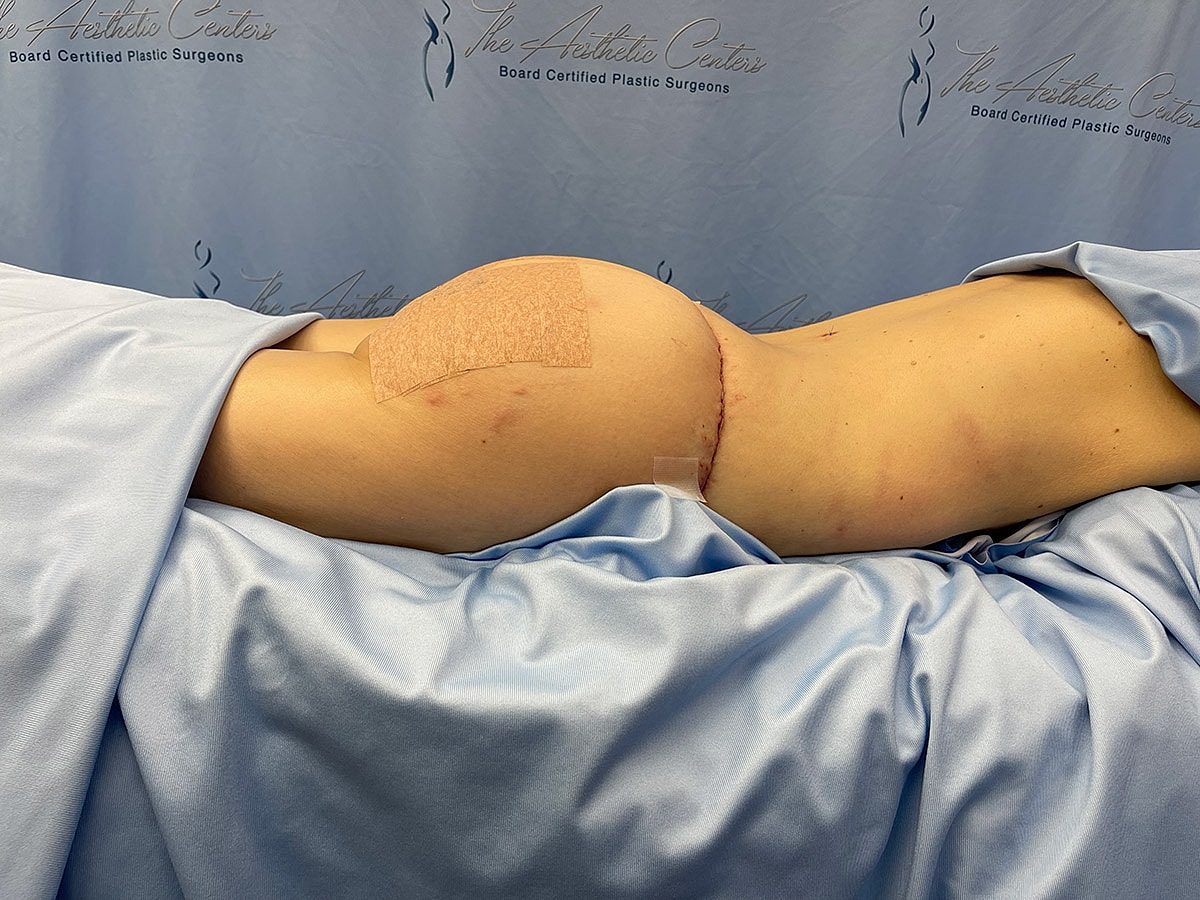 Post-surgery recovery in a medical setting.