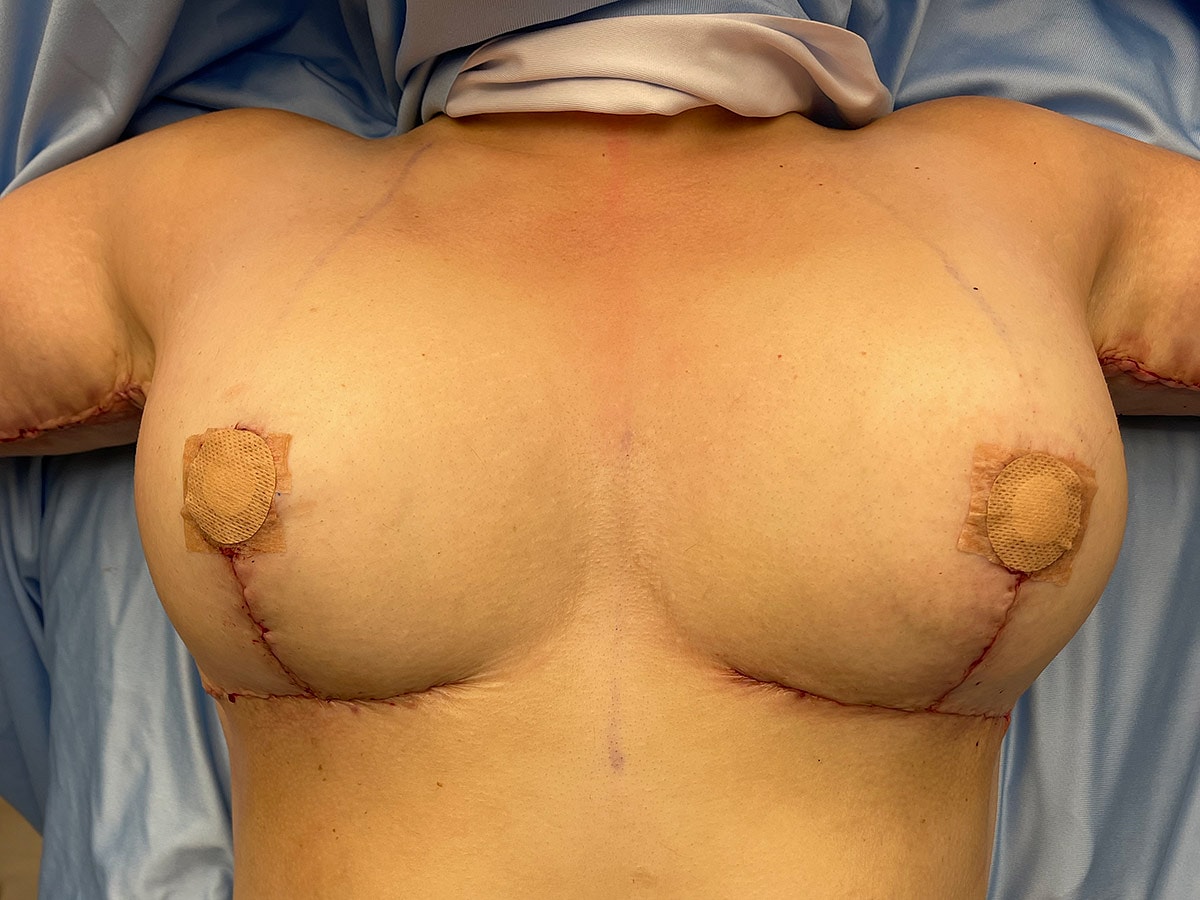 Post-surgical chest with healing incisions and dressings.