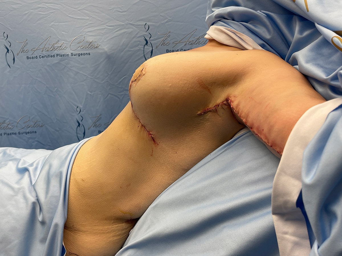 Post-surgical recovery of body contouring procedure.