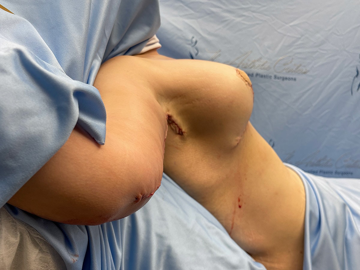 Post-surgical recovery showing stitches on torso.