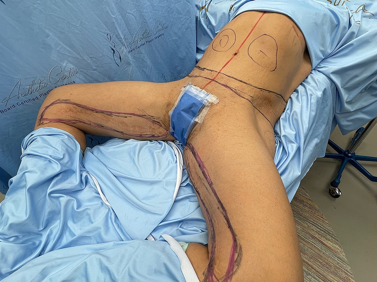 Patient prepped for surgical procedure with markings.