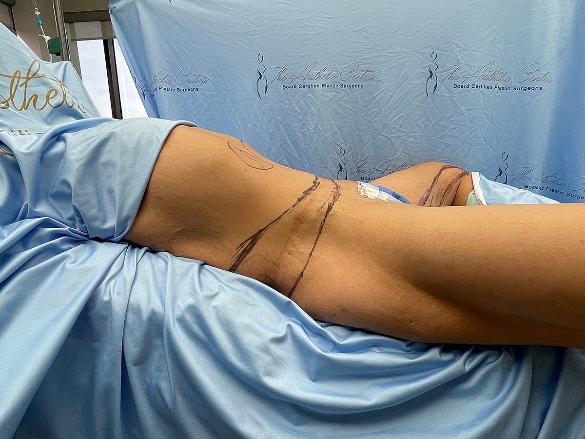 Patient preparing for plastic surgery procedure.