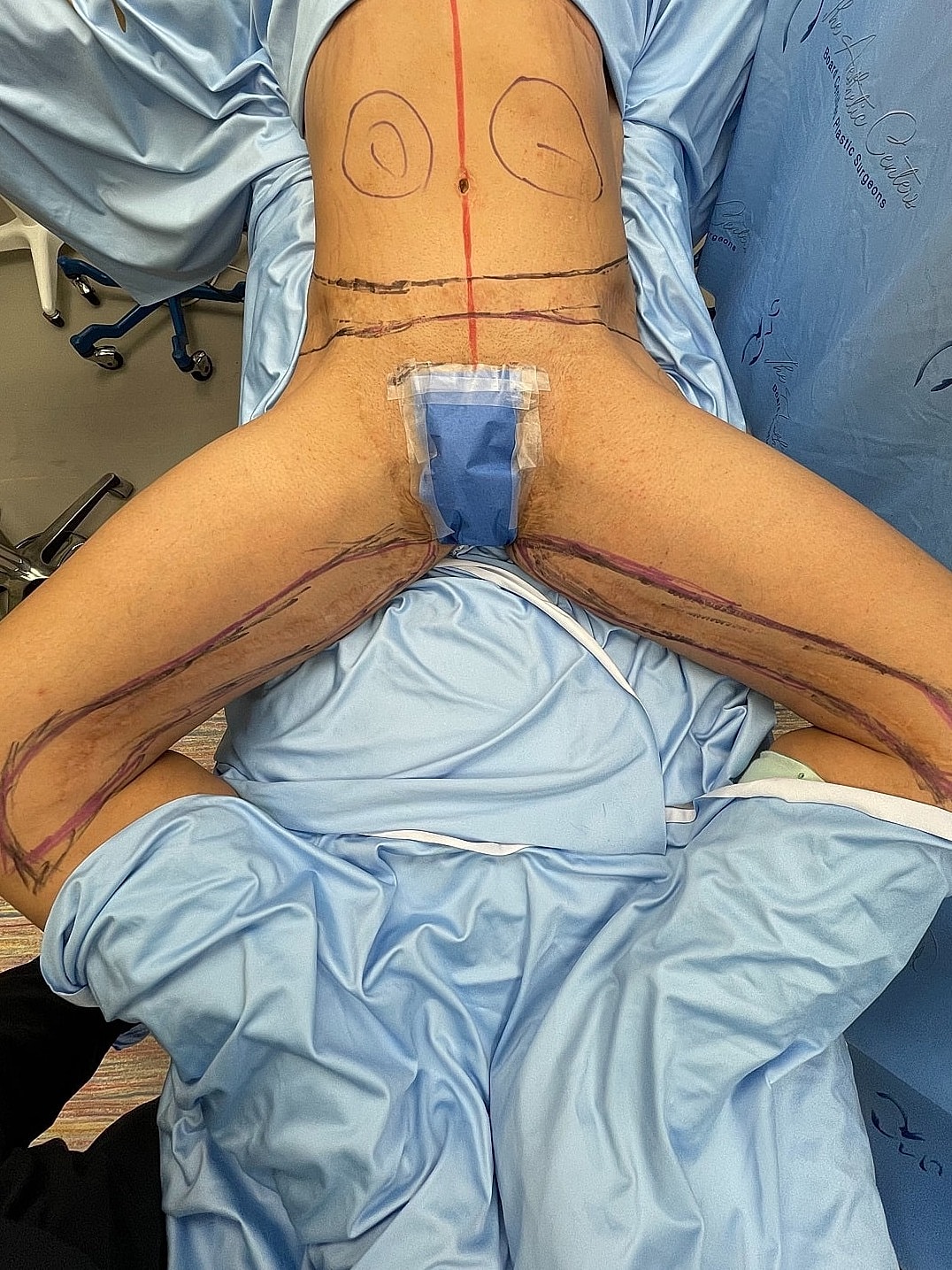Surgical preparation with markings on patient's body.