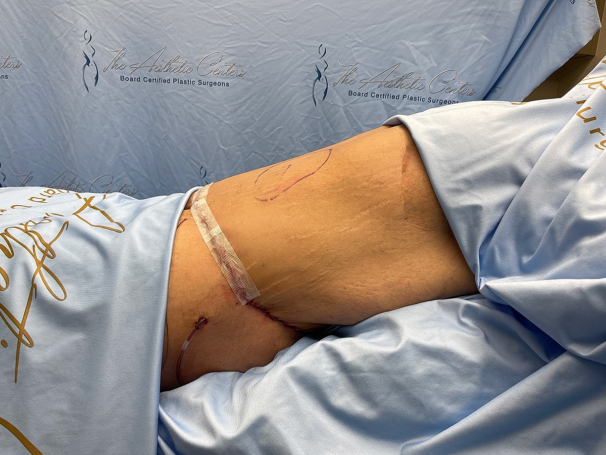 Medical recovery after surgery on abdomen area.