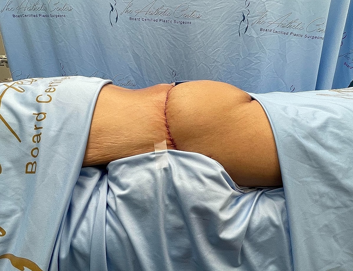 Surgical procedure with visible incision on lower back