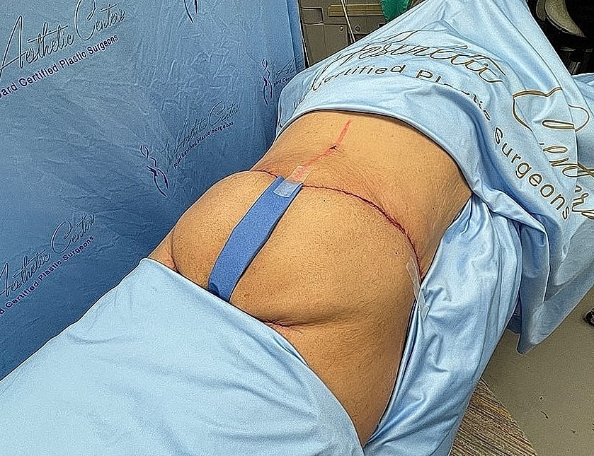 Surgical procedure with visible incision and draping.