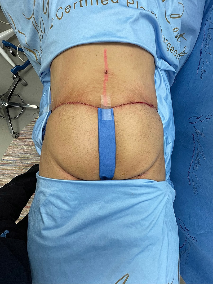 Surgical patient position for back procedure.