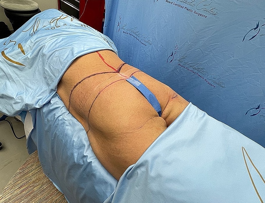 Patient preparing for cosmetic surgery procedure.