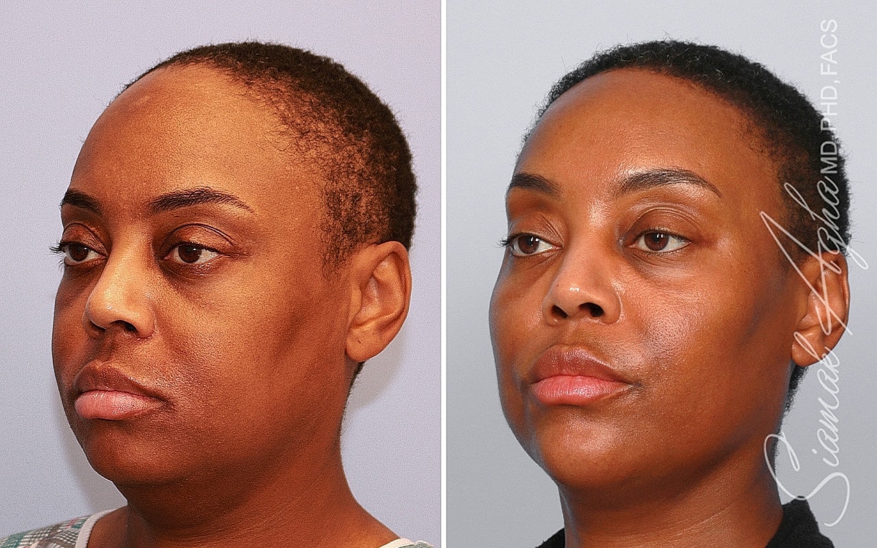 Before and after facial transformation comparison.