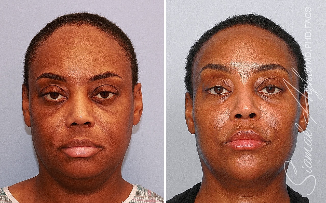 Before and after skin treatment comparison.