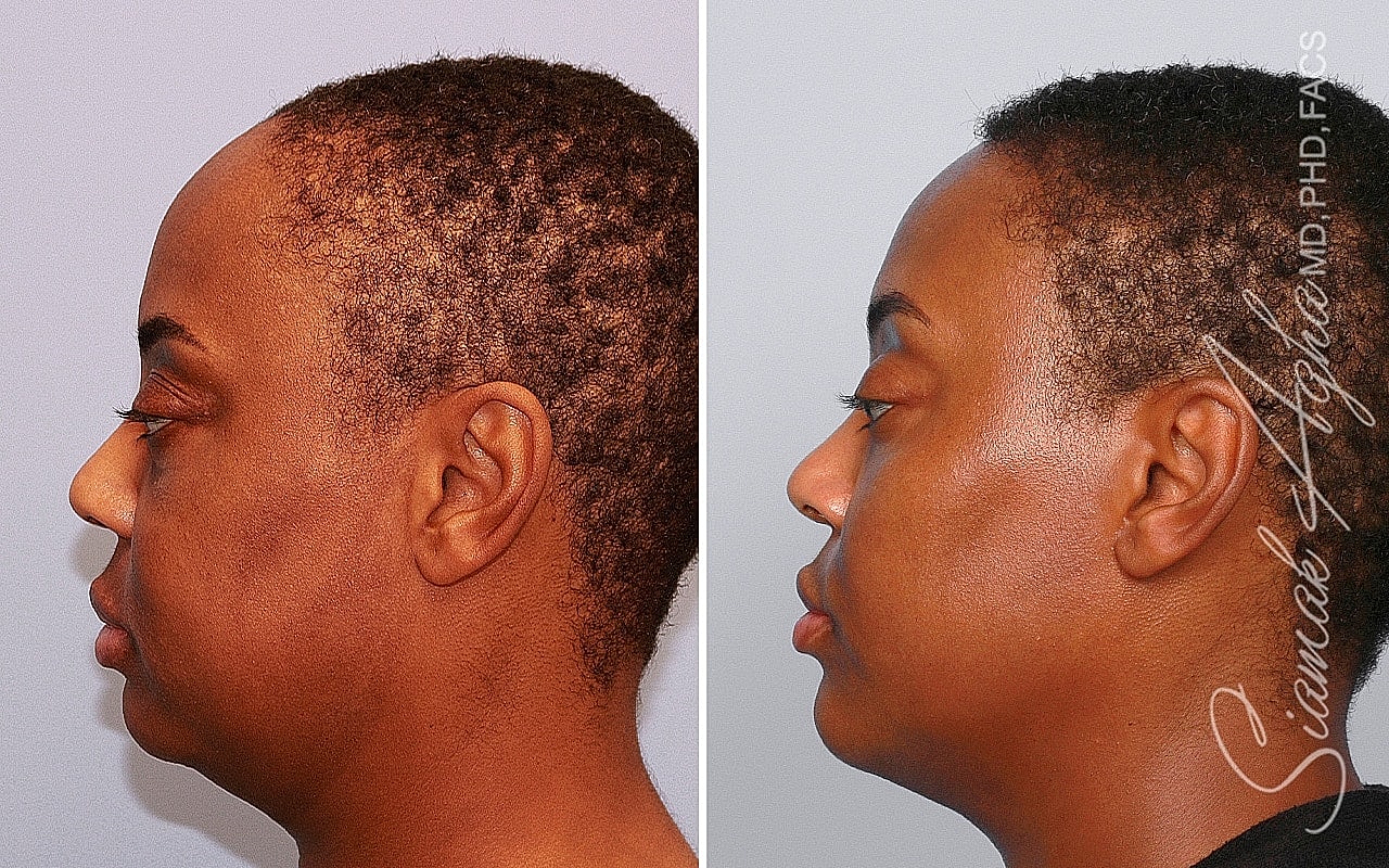 Profile view of a person before and after treatment.