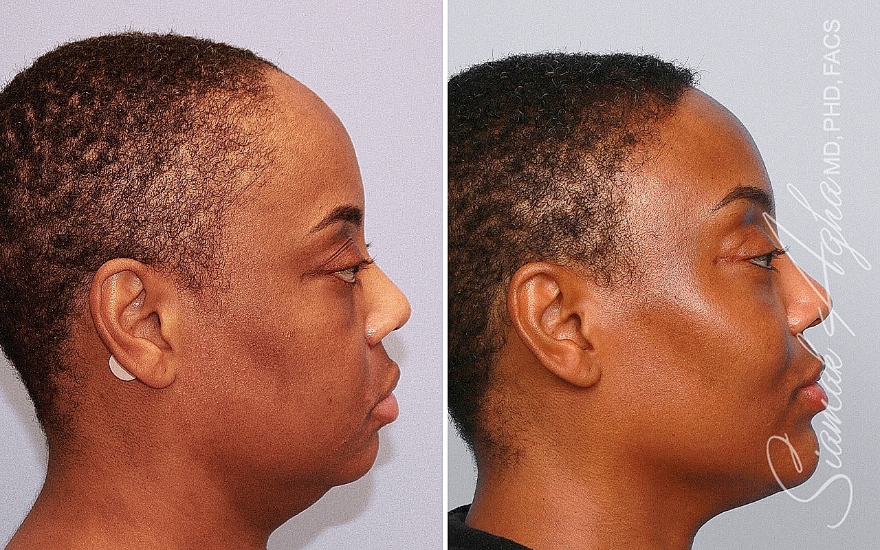 Before and after profile view of a person.