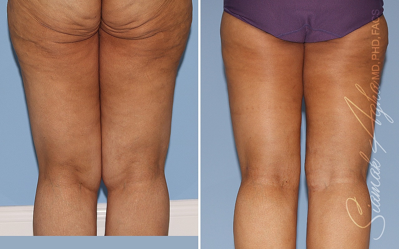 Before and after body contouring treatment comparison.