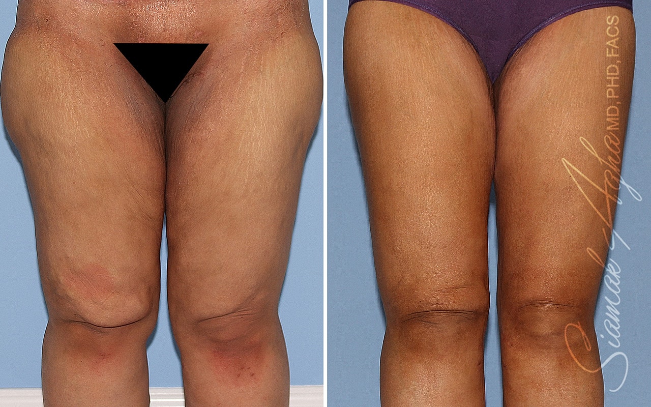 Before and after legs treatment comparison image.