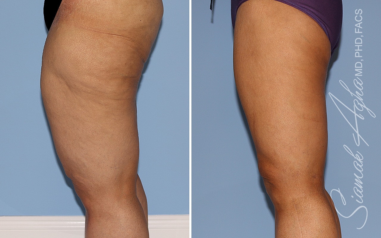 Before and after photos of leg transformation.