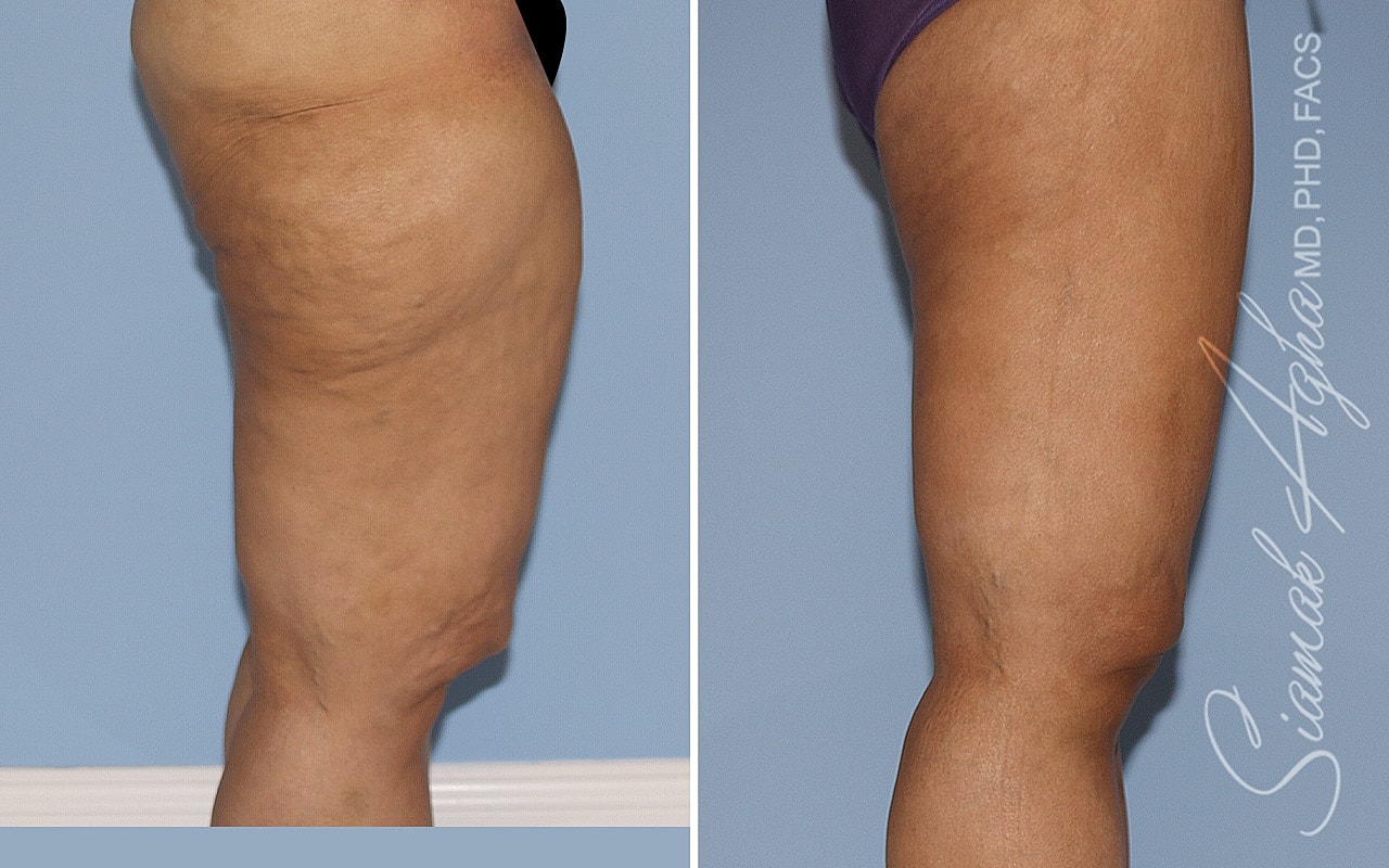Before and after of thigh appearance改善。