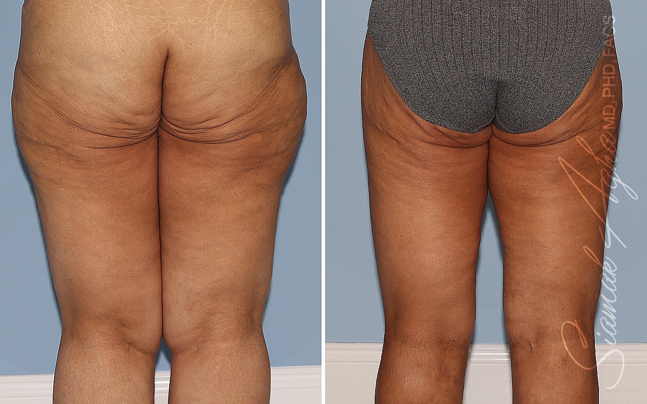 Before and after lower body treatment comparison.