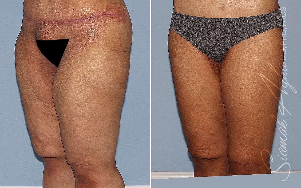 Before and after thigh appearance comparison.