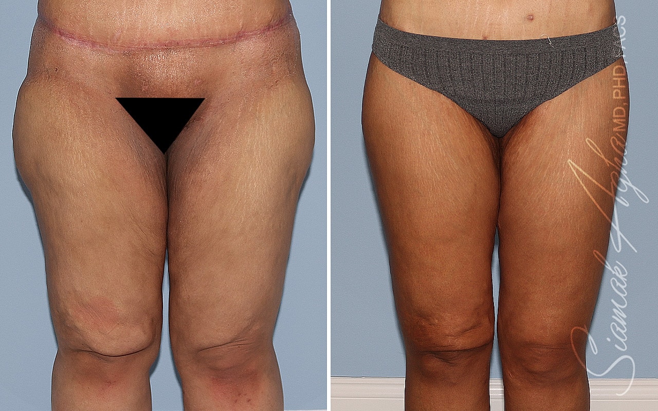 Before and after thigh treatment comparison image.