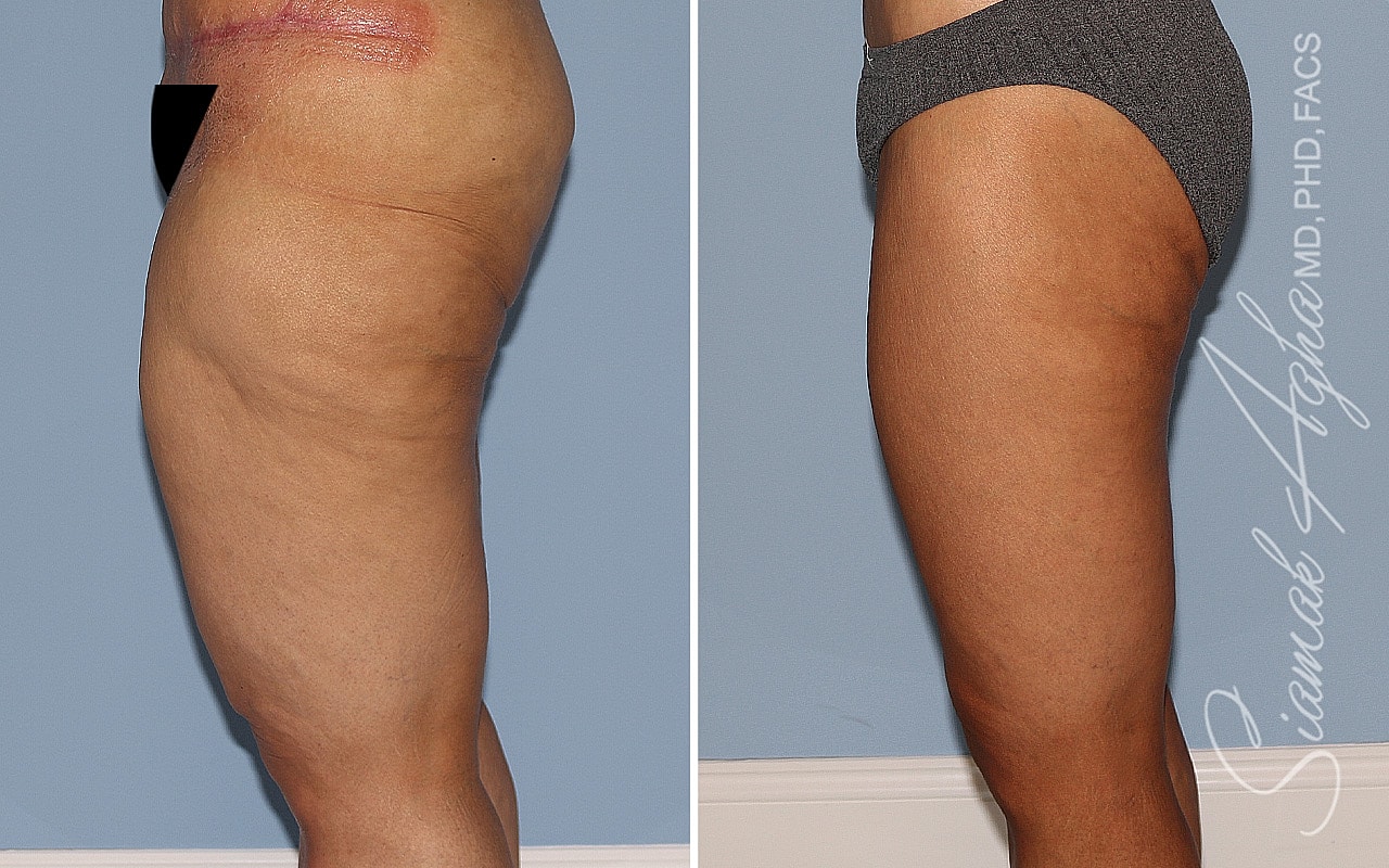 Before and after thigh transformation comparison.