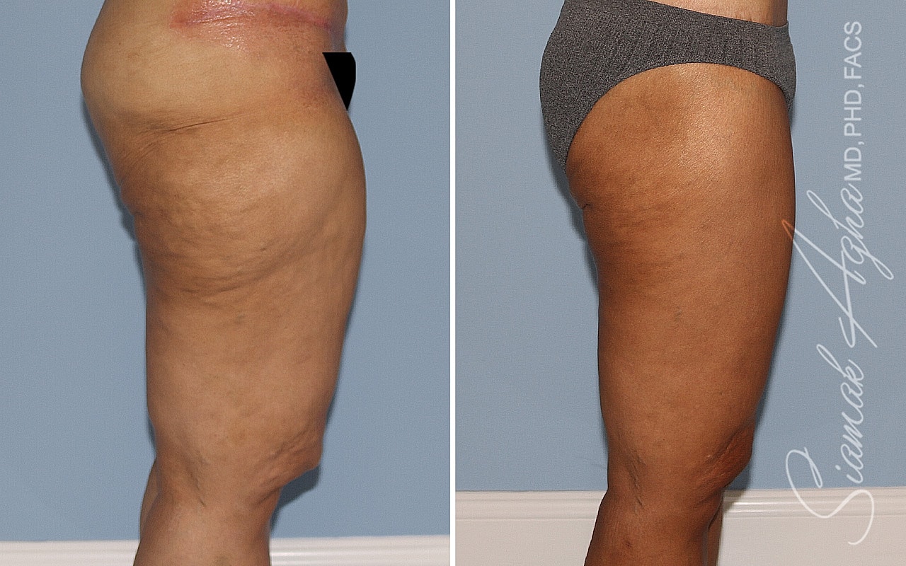 Before and after body contouring results