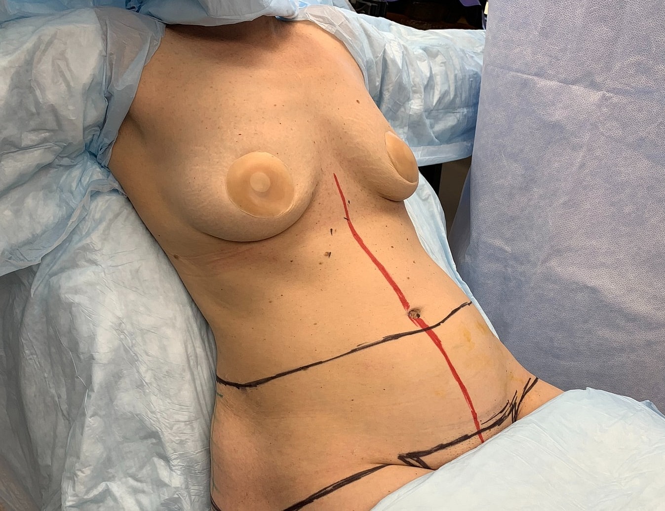 Surgical markings on torso before procedure.