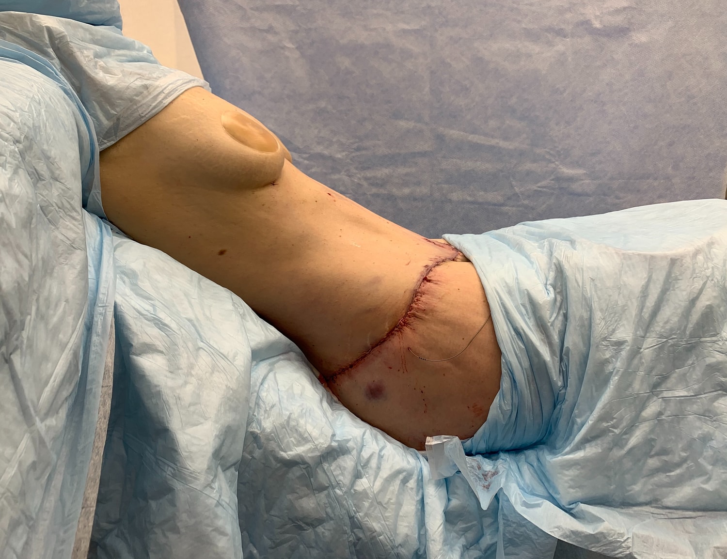 Surgical procedure with visible incision and sutures.