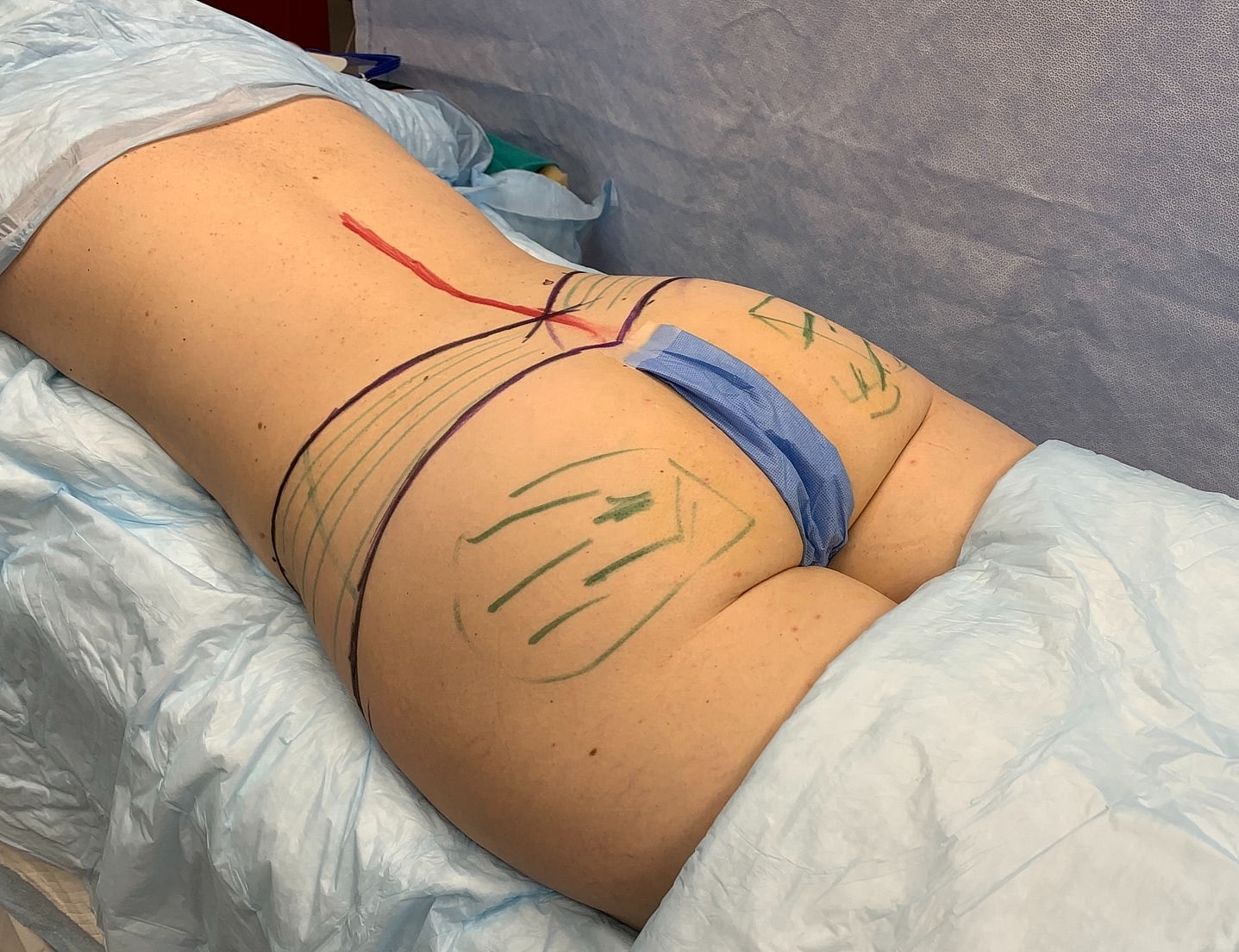 Surgical markings on a patient's lower back.