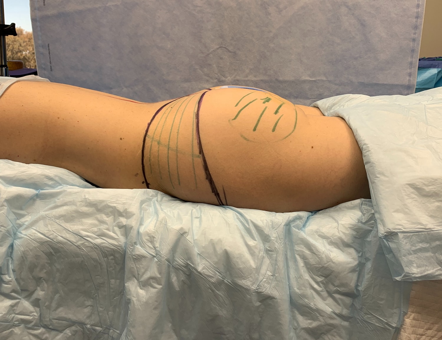Patient's side with markings for medical procedure.