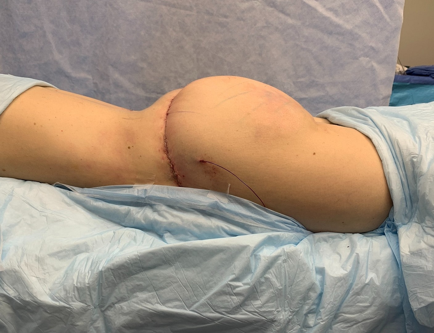 Surgical procedure on patient's lower back area.