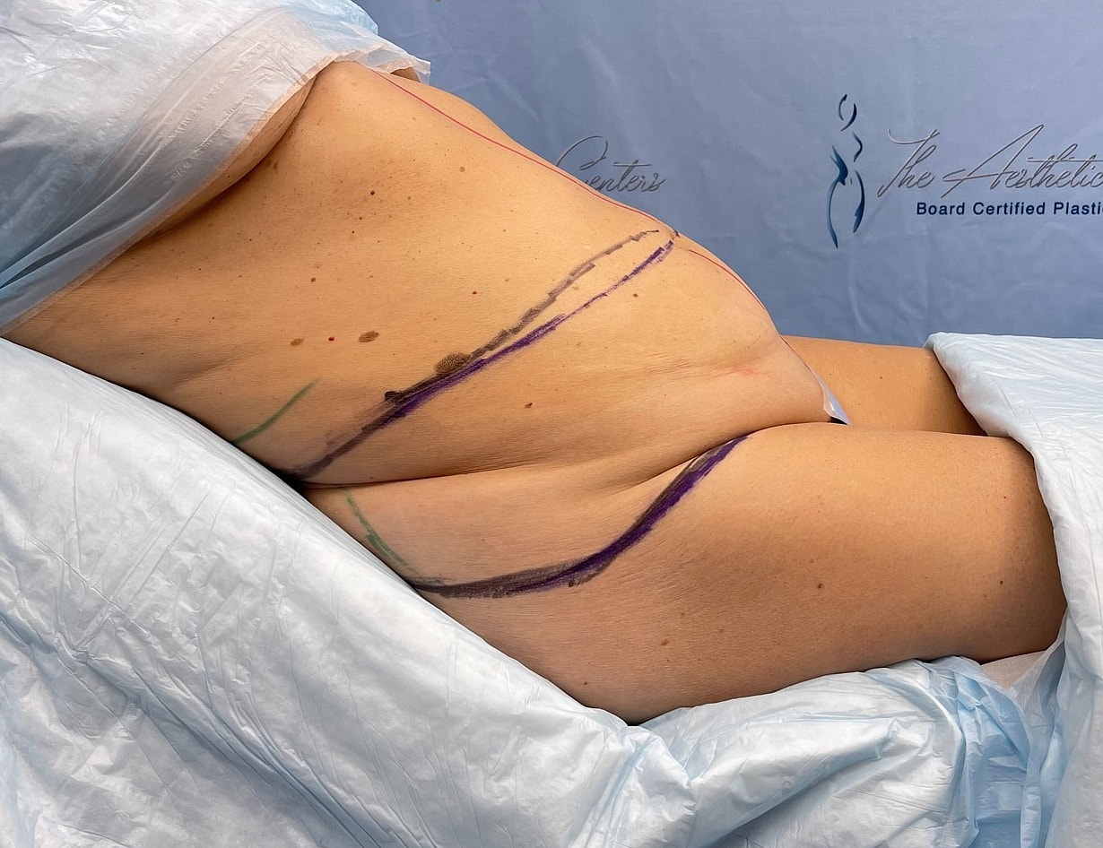 Surgical markings on a patient's side before procedure.