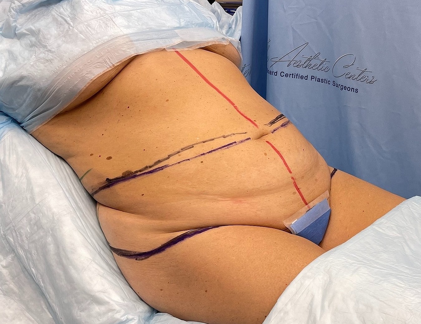 Surgical markings on a patient’s abdomen.