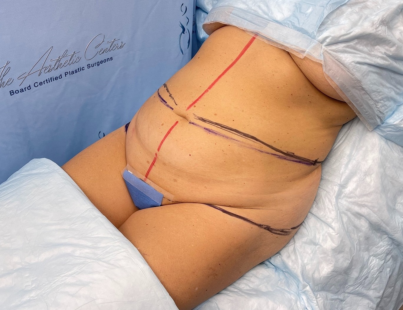 Patient prepared for body contouring procedure.