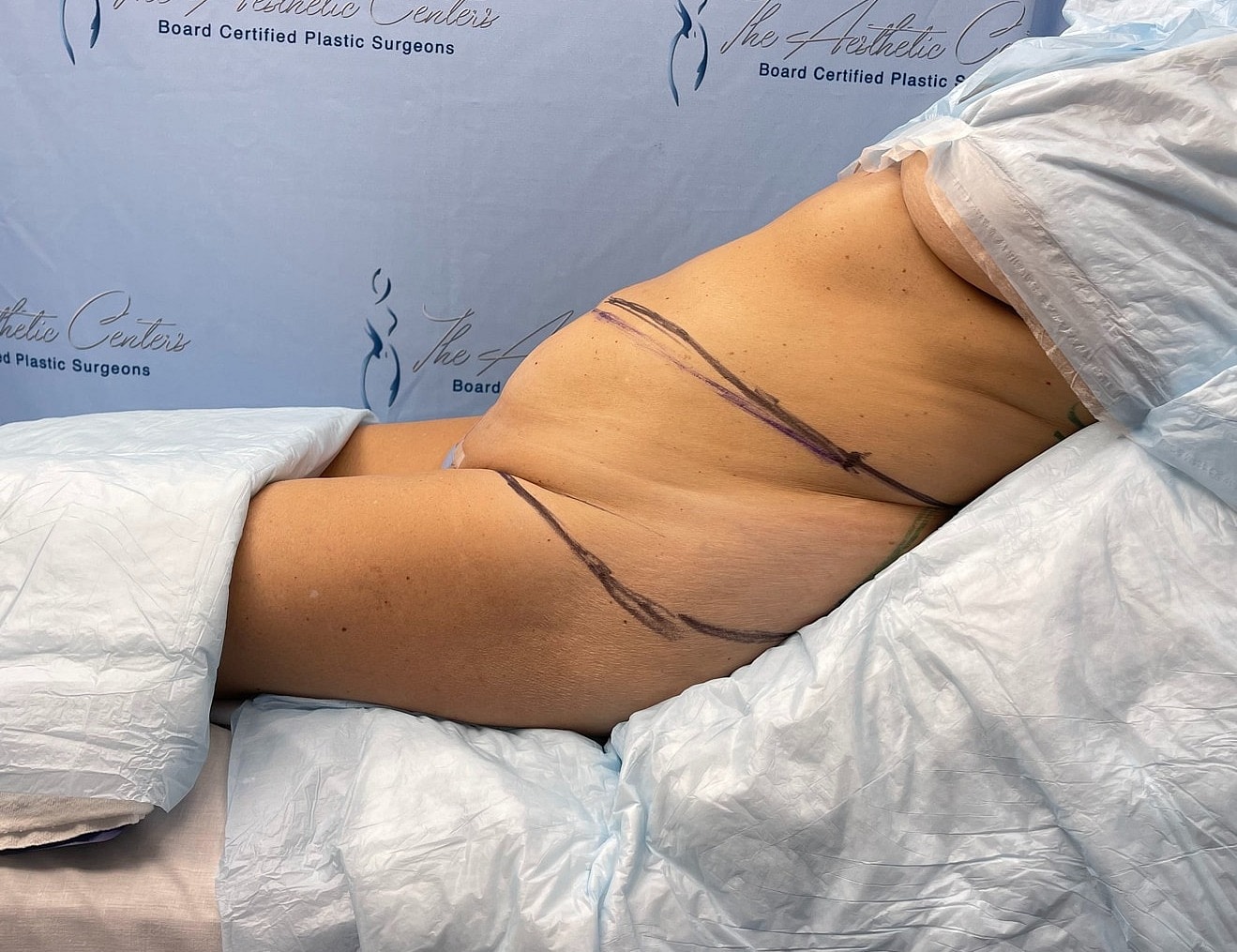 Patient preparing for cosmetic surgery procedure.