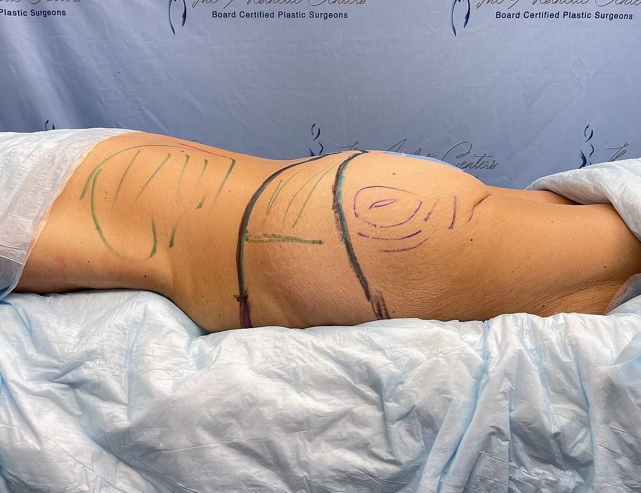 Patient preparation for plastic surgery procedure.