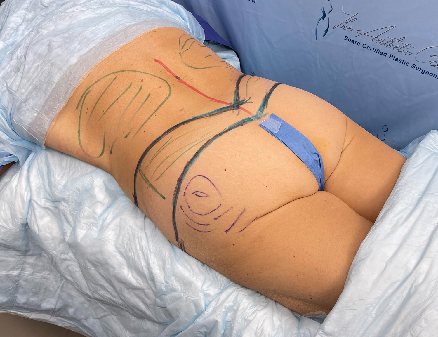 Body markings for cosmetic surgery preparation.