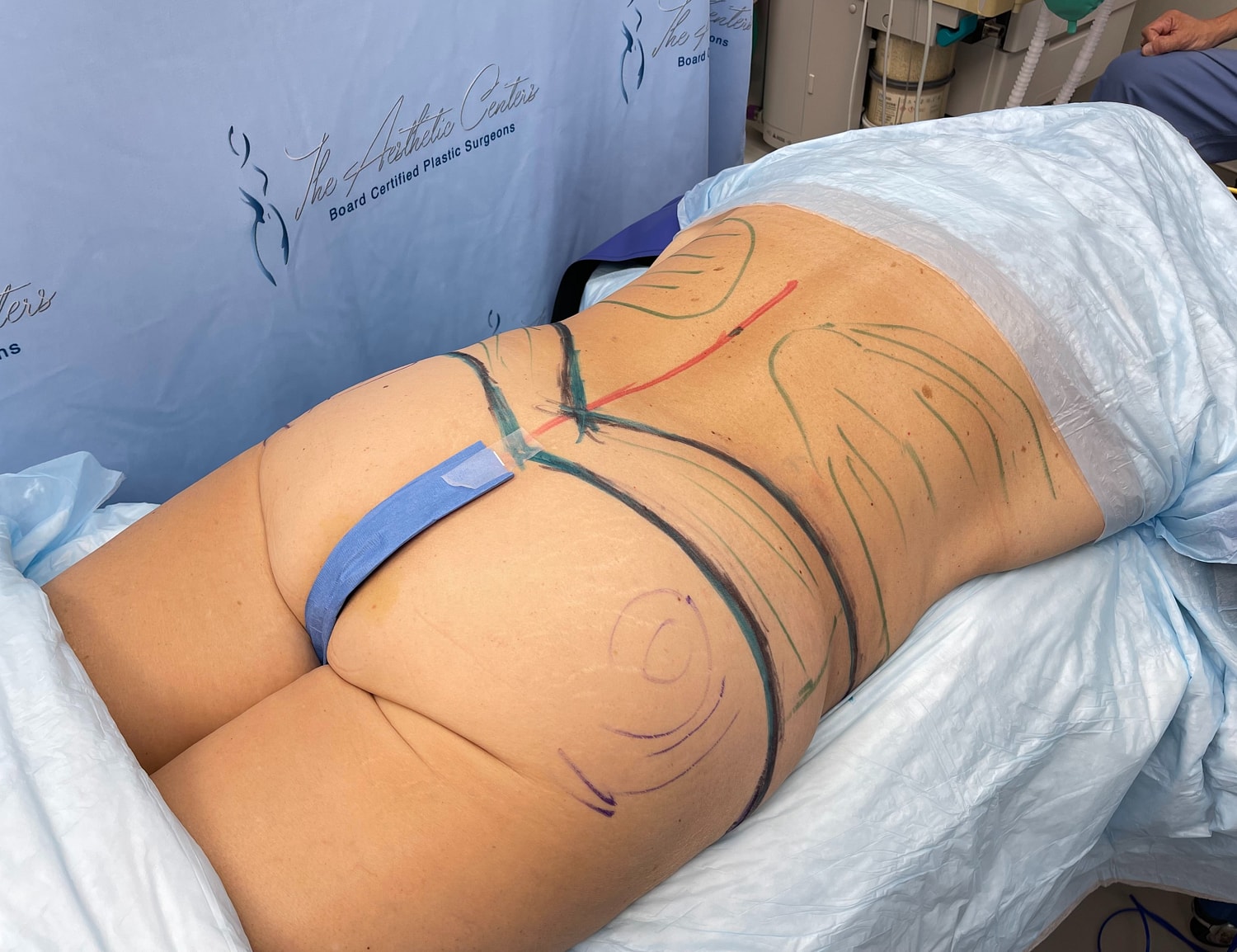 Pre-operative markings for body contouring surgery.