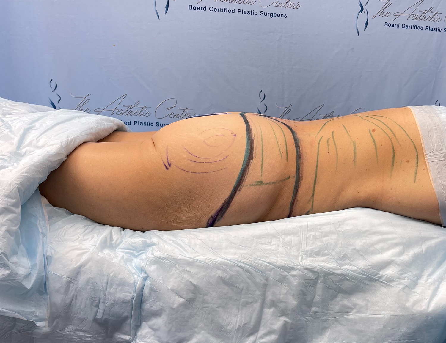Body contouring markings on patient’s side.