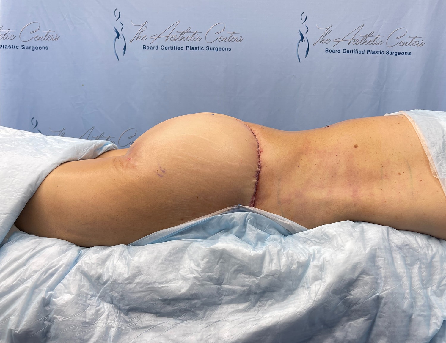 Post-surgical body contouring procedure image.