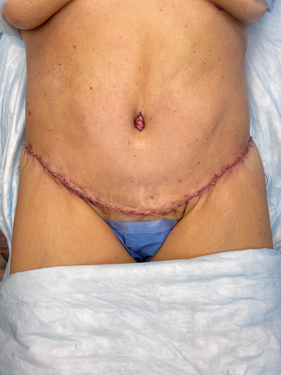 Post-surgery abdomen with visible stitches and bandages.