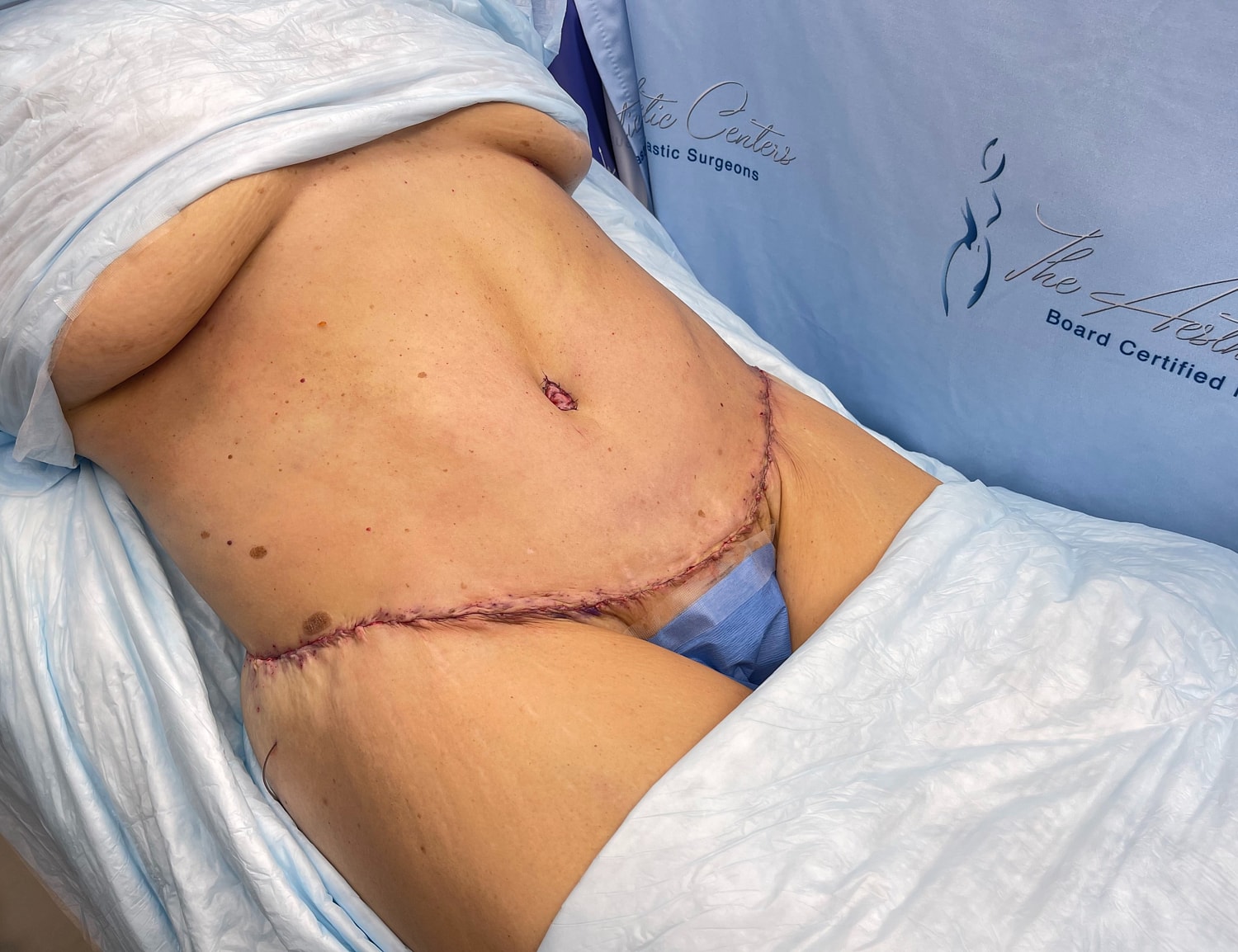 Post-surgical abdomen with visible stitches.