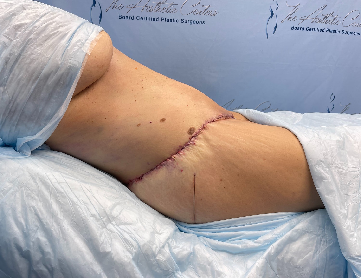 Surgical incision on a patient's abdomen area.