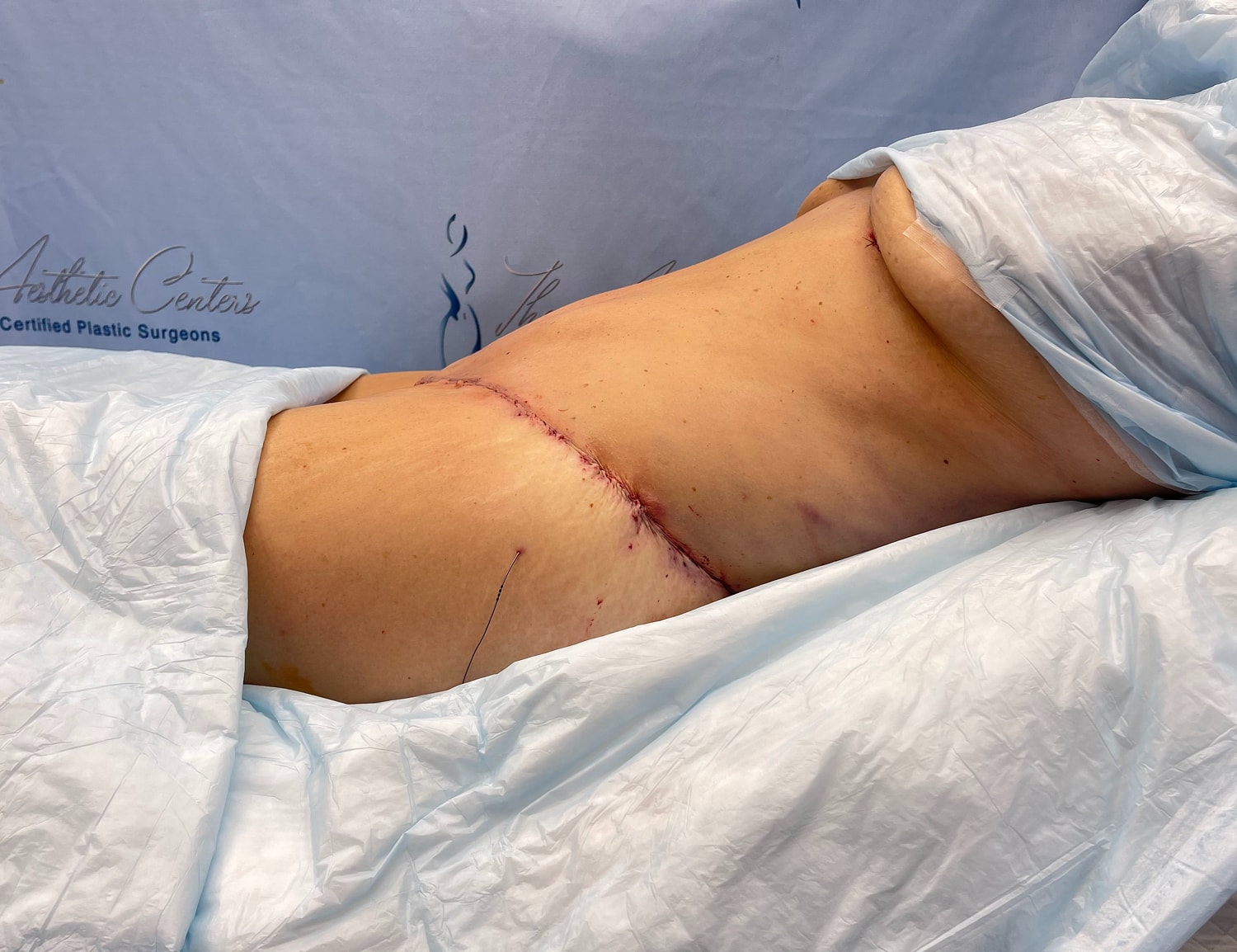 Post-surgery abdomen with surgical stitches visible.