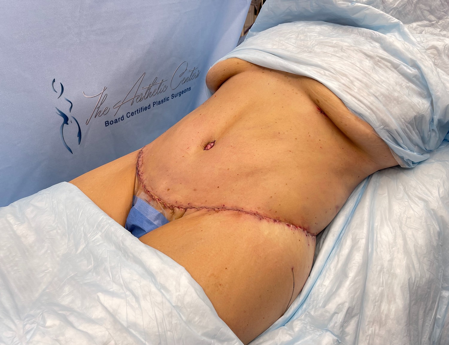 Post-surgical recovery with visible incision site.